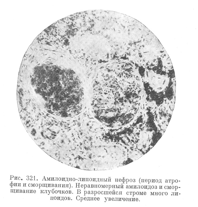 Нефропатия беременных  (nephropathia gravidarum)