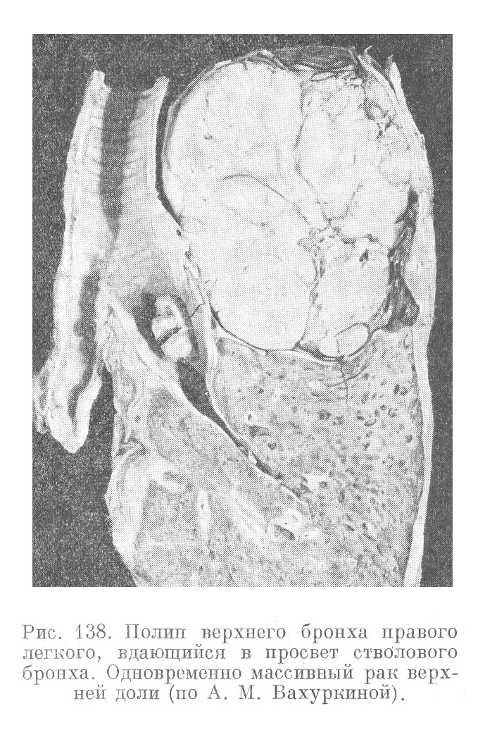 Полип верхнего бронха правого легкого, вдающийся в просвет стволового бронха. Одновременно массивный рак верхней доли (по А. М. Вахуркиной).