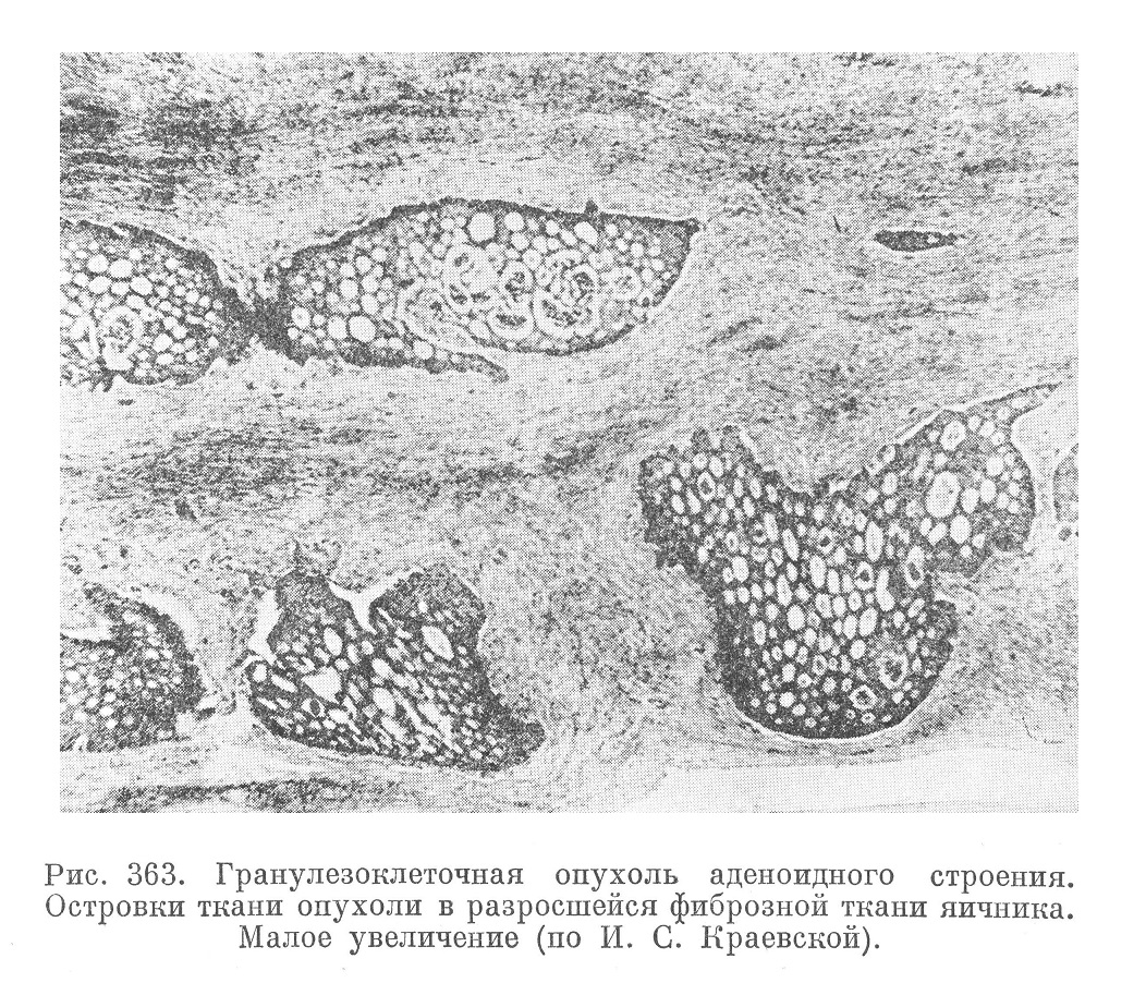 Гранулезоклеточная опухоль аденоидного строения. Островки ткани опухоли в разросшейся фиброзной ткани яичника. Малое увеличение (по И. С. Краевской).
