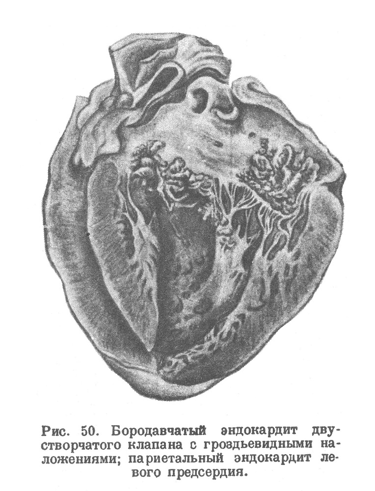 Бородавчатый эндокардит двустворчатого клапана с гроздьевидными наложениями; париетальный эндокардит левого предсердия.