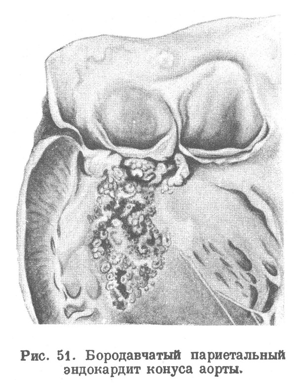 Бородавчатый париетальный эндокардит конуса аорты.