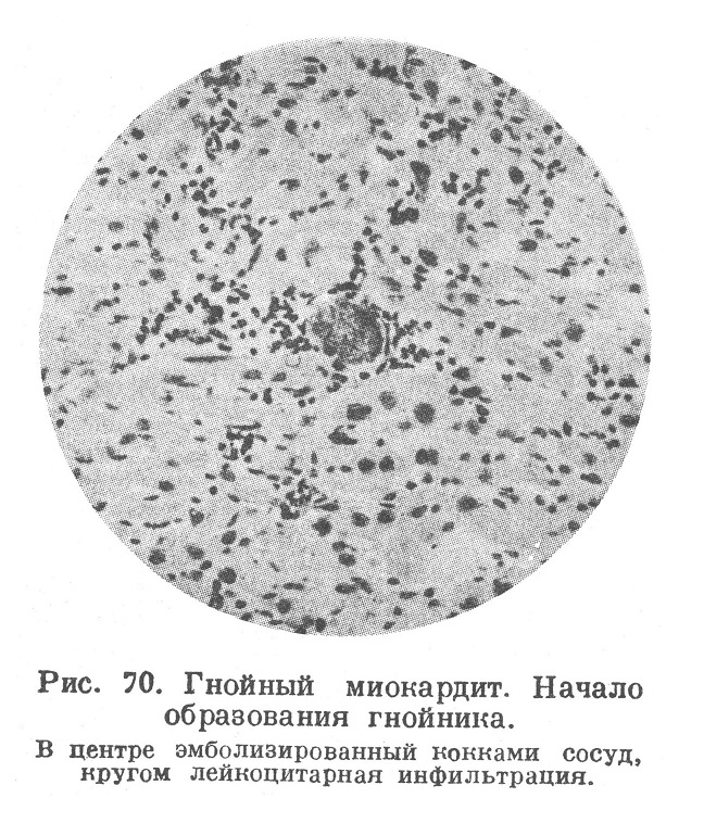 Гнойный миокардит. Начало образования гнойника. В центре эмболизированный кокками сосуд, кругом лейкоцитарная инфильтрация.