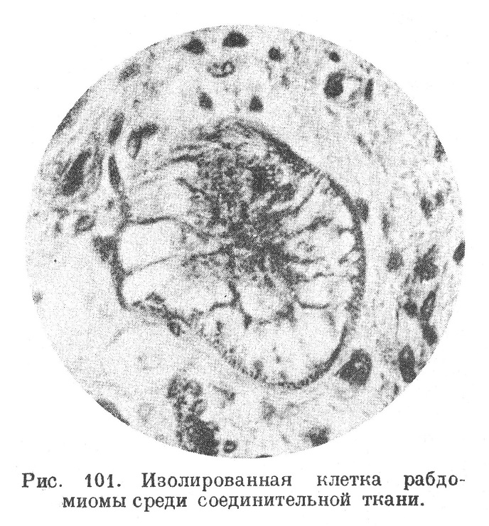 Изолированная клетка рабдомиомы среди соединительной ткани