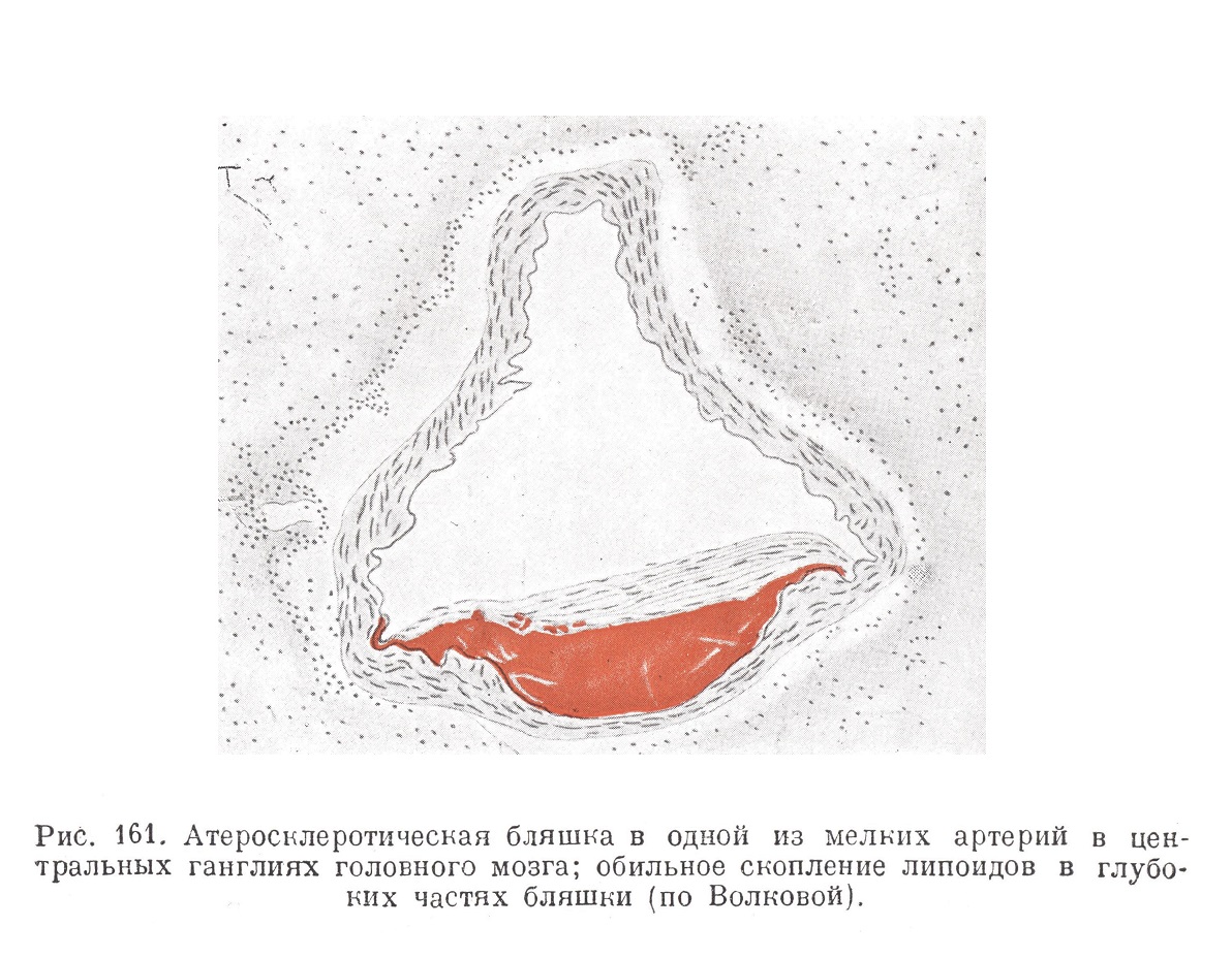 Атеросклеротическая бляшка в артерии