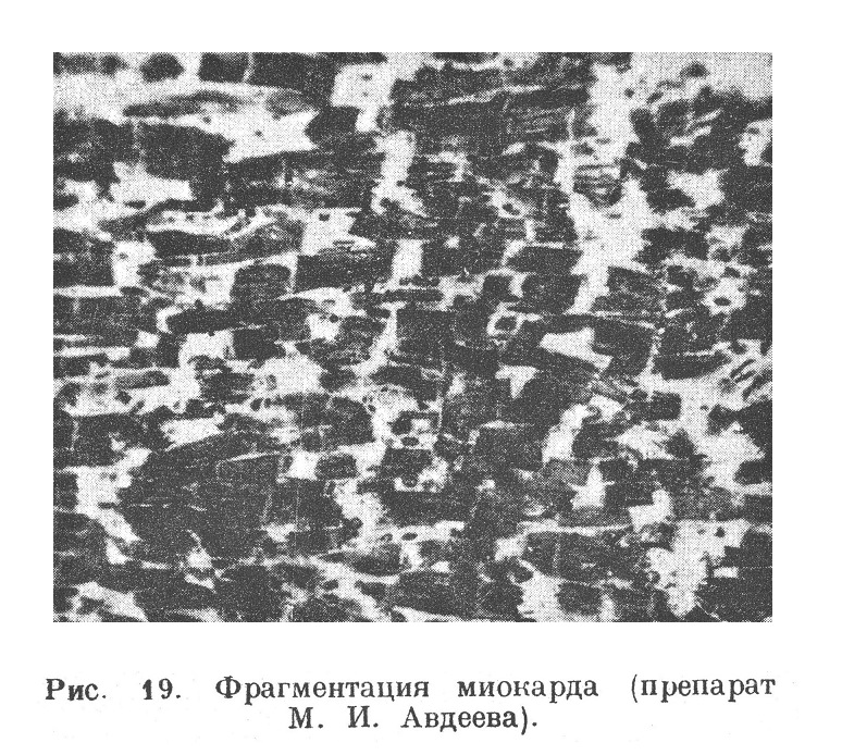 Фрагментация миокарда (препарат М. И. Авдеева).