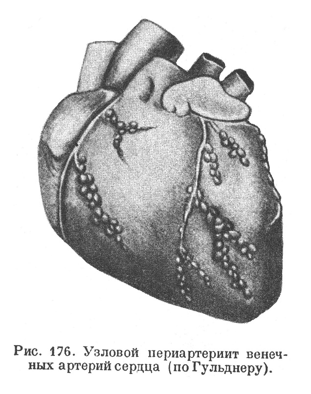 Узловой периартериит венечных артерий сердца