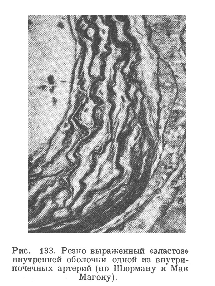 Резко выраженный «эластоз» внутренней оболочки одной из внутри почечных артерий (по Шюрману и Мак Магону).