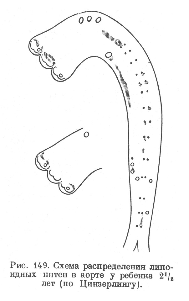 Схема распределения липоидных пятен в аорте у ребенка 2,5 года