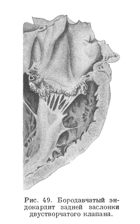 Бородавчатый эндокардит (endocarditis verrucosa)
