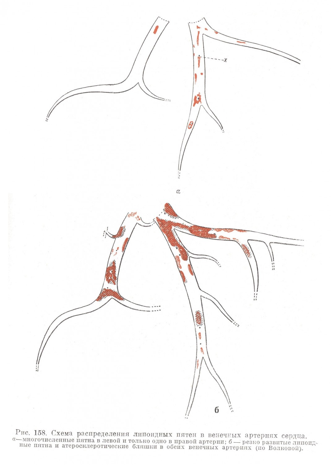 Схема распределения липоидных пятен в артериях сердца