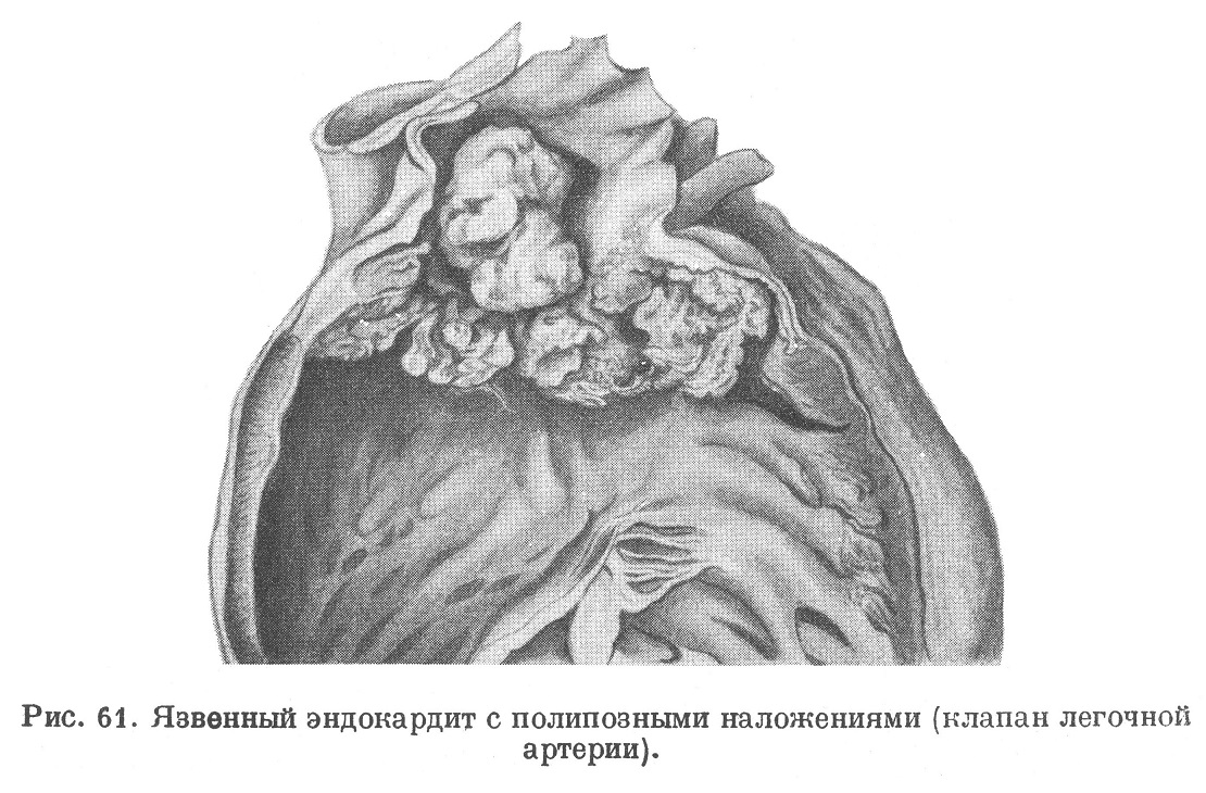 Язвенный эндокардит с полипозными наложениями (клапан легочной артерии).