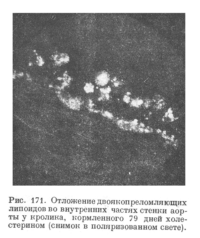 Отложение двоякопреломляющих липоидов во внутренних частях стенки аорты у кролика, кормленного 79 дней холестерином (снимок в поляризованном свете).