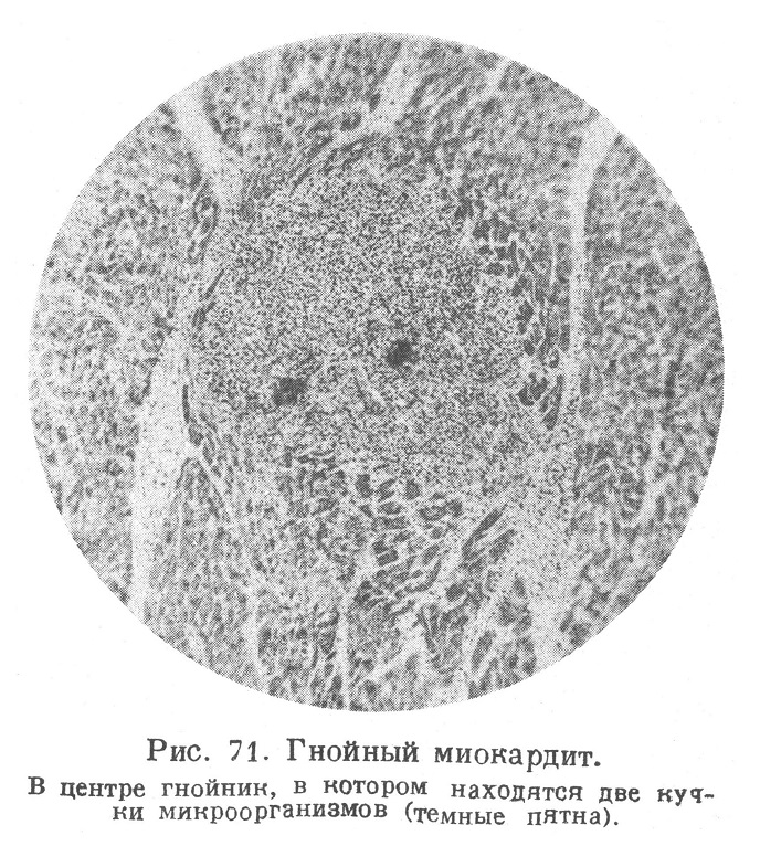 Гнойный миокардит. В центре гнойник, в котором находятся две кутки микроорганизмов (темные пятна).