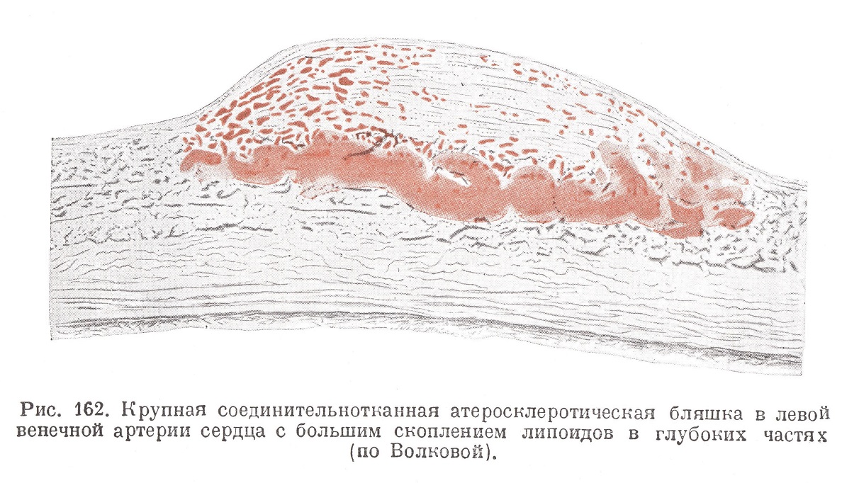 Крупная соединительно-тканная атеросклеротическая бляшка