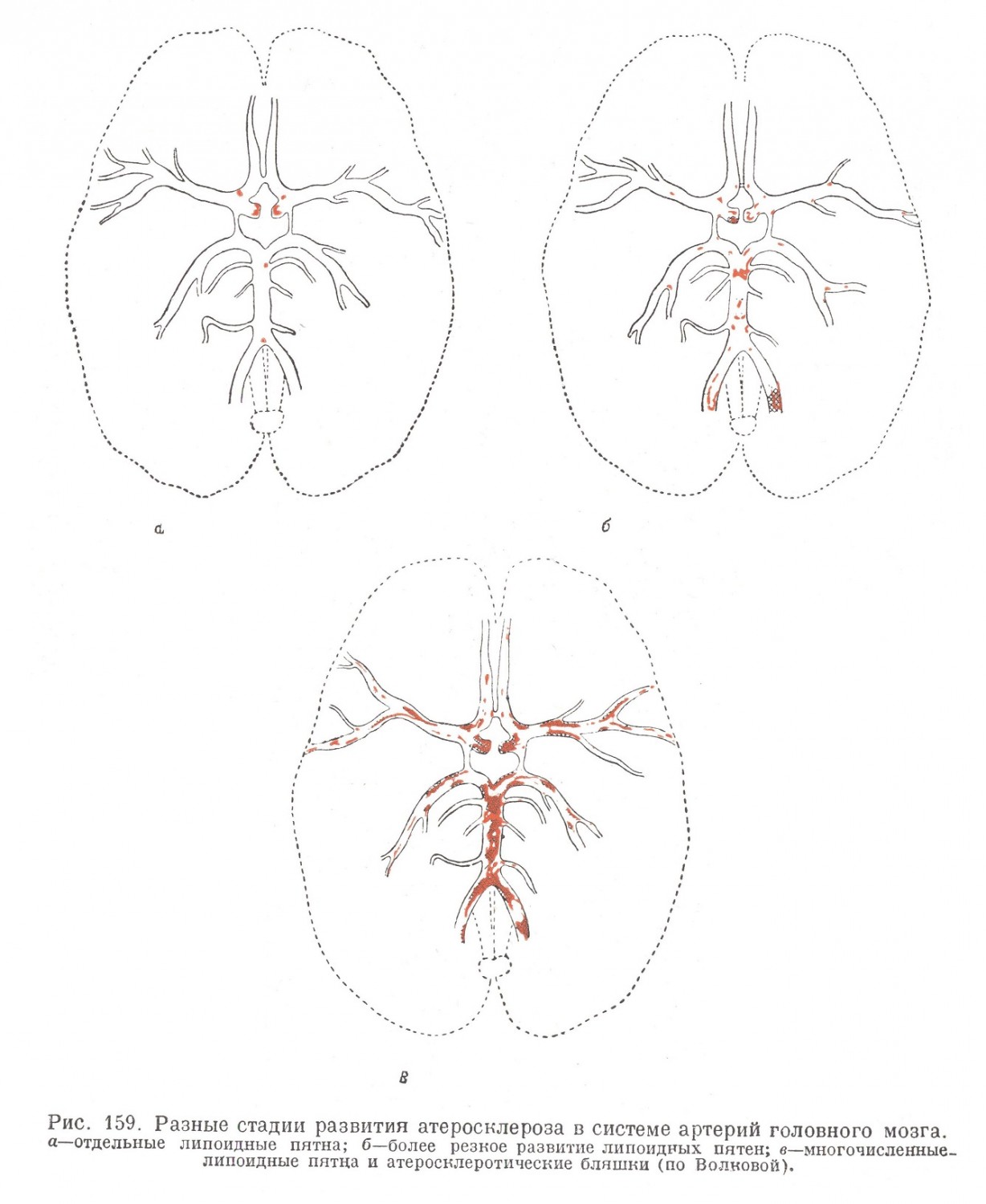 Разные стадии развития атеросклероза в системе артерий головного мозга