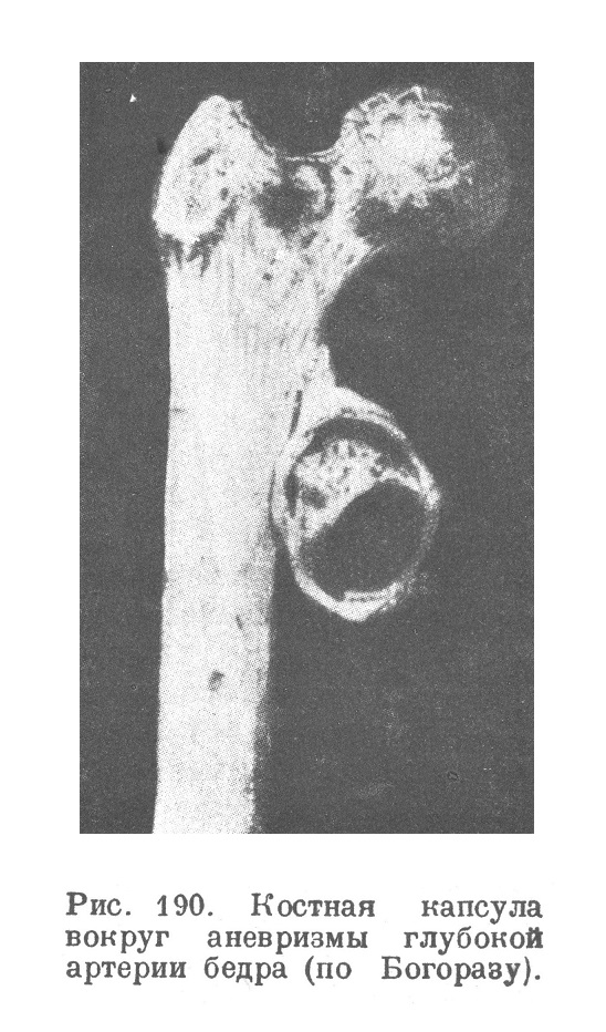 Костная капсула вокруг аневризмы глубокой артерии бедра (по Богоразу).