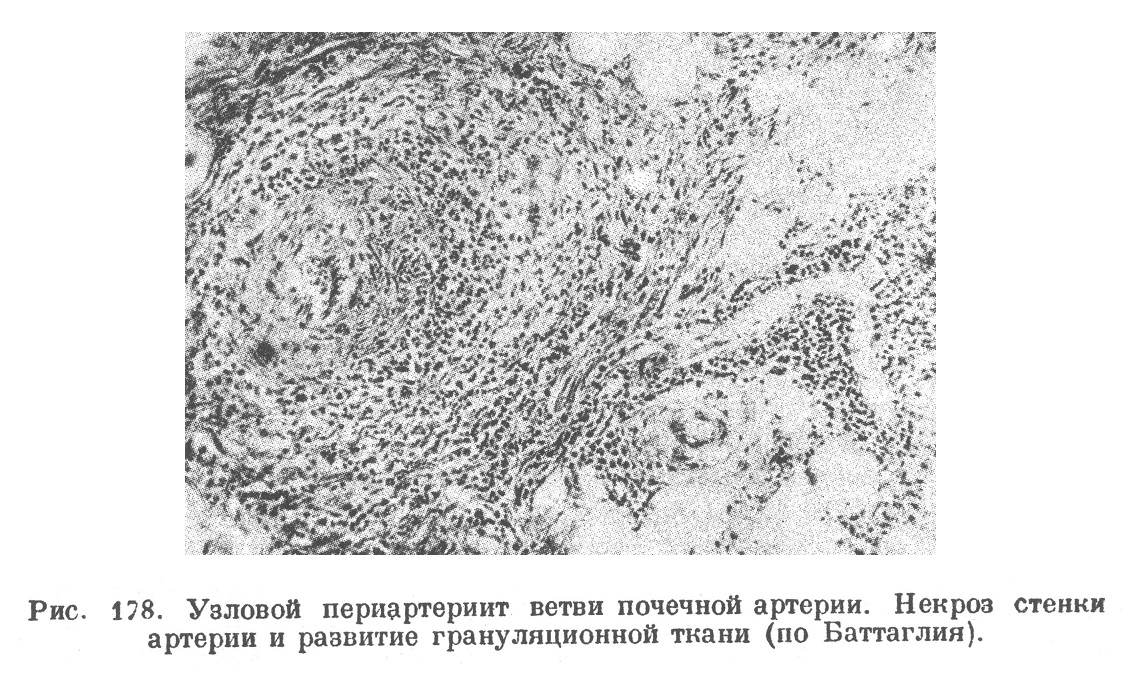 Узловой периартериит ветви почечной артерии. Некроз стенки артерии и развитие грануляционной ткани (по Баттаглия).