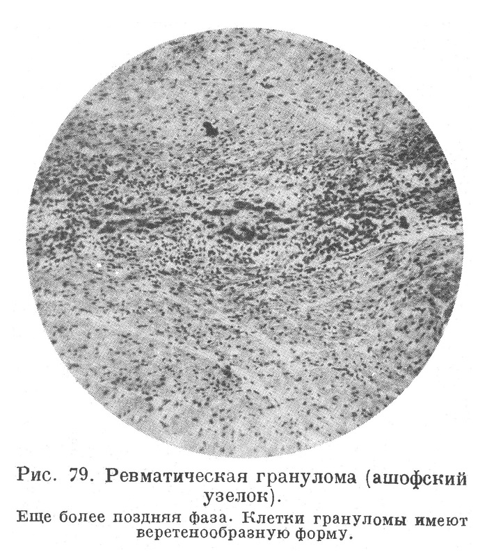 Ревматическая гранулома (ашофский узелок). Еще более поздняя фаза. Клетки грануломы имеют веретенообразную форму.