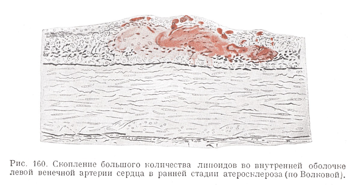 Скопление большого количества липоидов во внутренней оболочки артерии