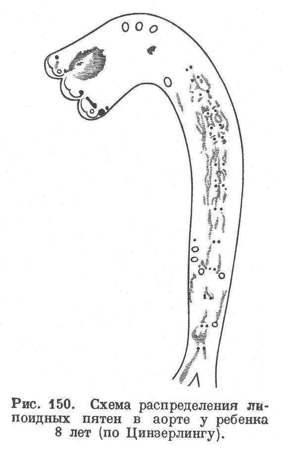 Схема распределения липоидных пятен в аорте у ребенка 8 лет