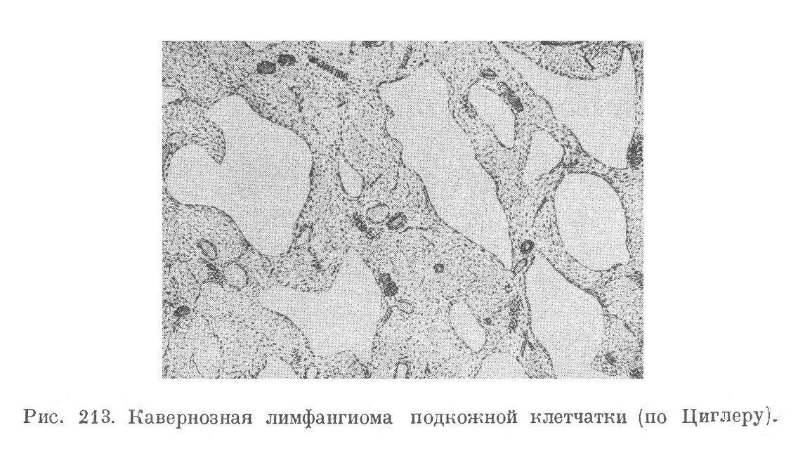 Кавернозная лимфангиома подкожной клетчатки (по Циглеру).
