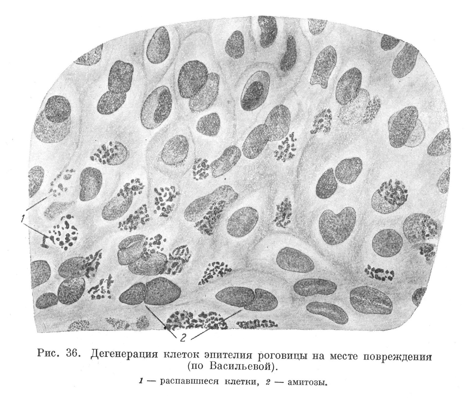 Дегенерация клеток эпителия роговицы на месте повреждения (по Васильевой).
