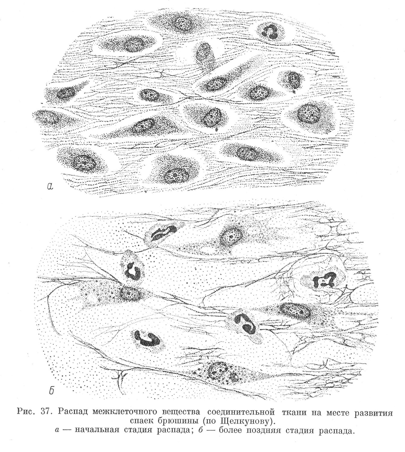 Распад межклеточного вещества соединительной ткани на месте развития спаек брюшины (по Щелкунову).