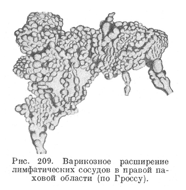 Варикозное расширение лимфатических сосудов в правой паховой области (по Гроссу).